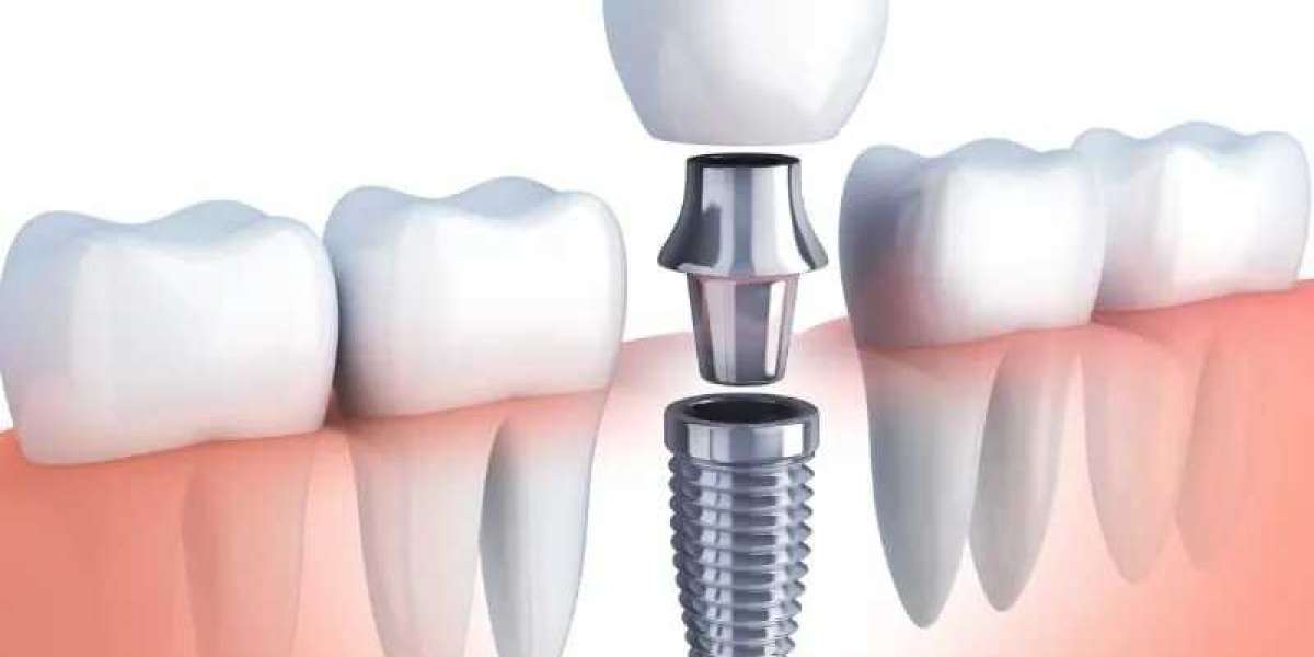 Understanding Bone Grafting in Dentistry: Procedure, Benefits, and Recovery